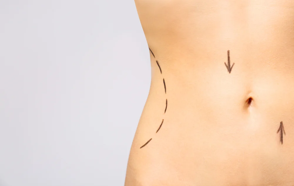 What are the Benefits of Non-Surgical Body Contouring?