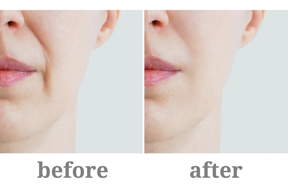 What You Should Know About Bellafill® - Duluth Medspa by Aging Young
