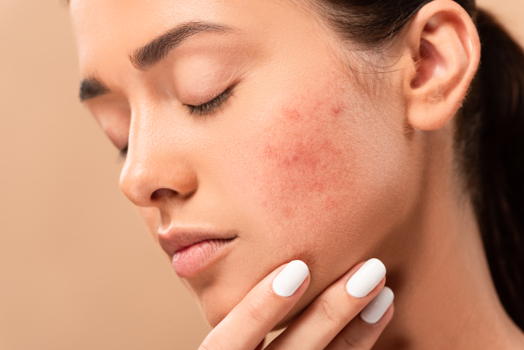 Close-up of a woman with acne-prone skin treated using LightStim acne therapy.