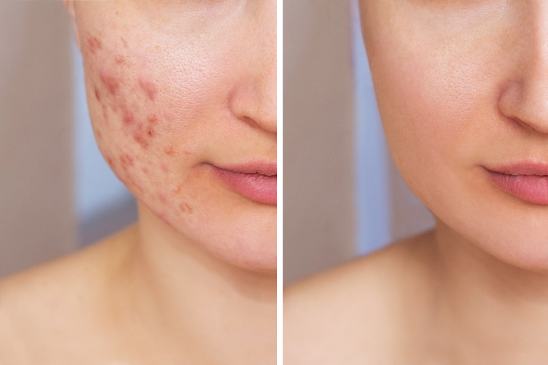 Before-and-after images showcasing the results of LightStim acne treatment.