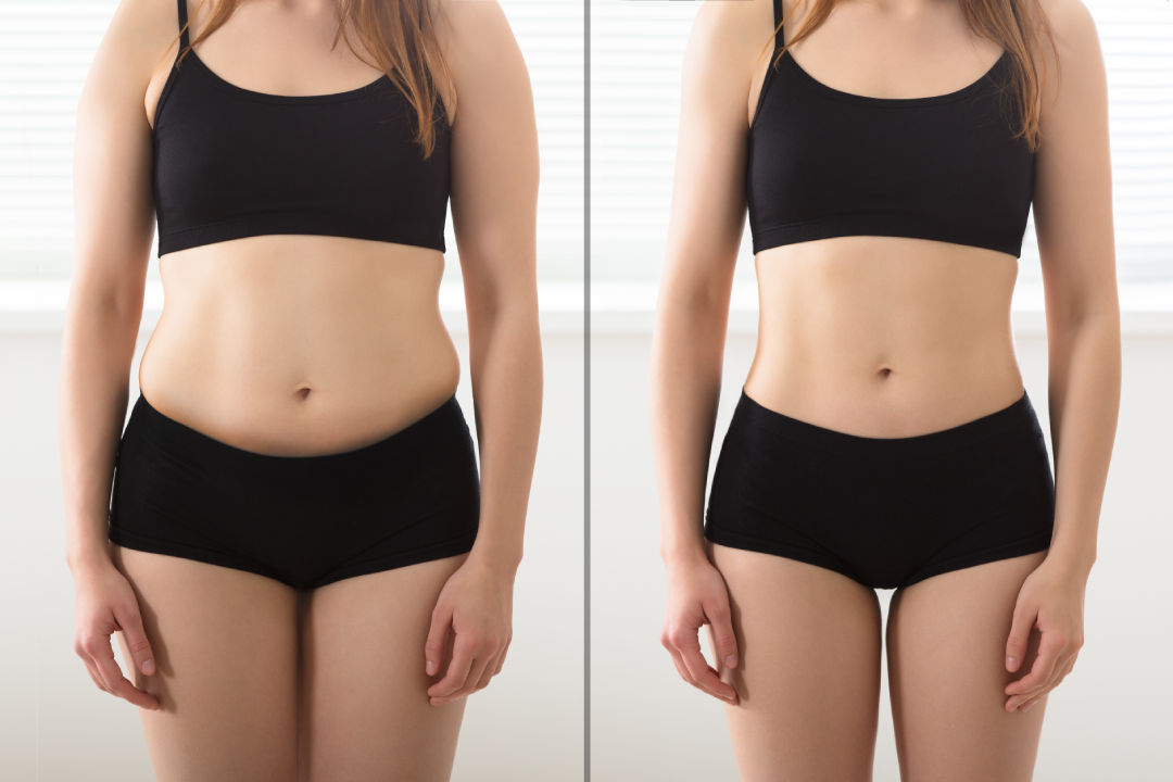 A before-and-after comparison showcasing the effects of Semaglutide on weight loss.