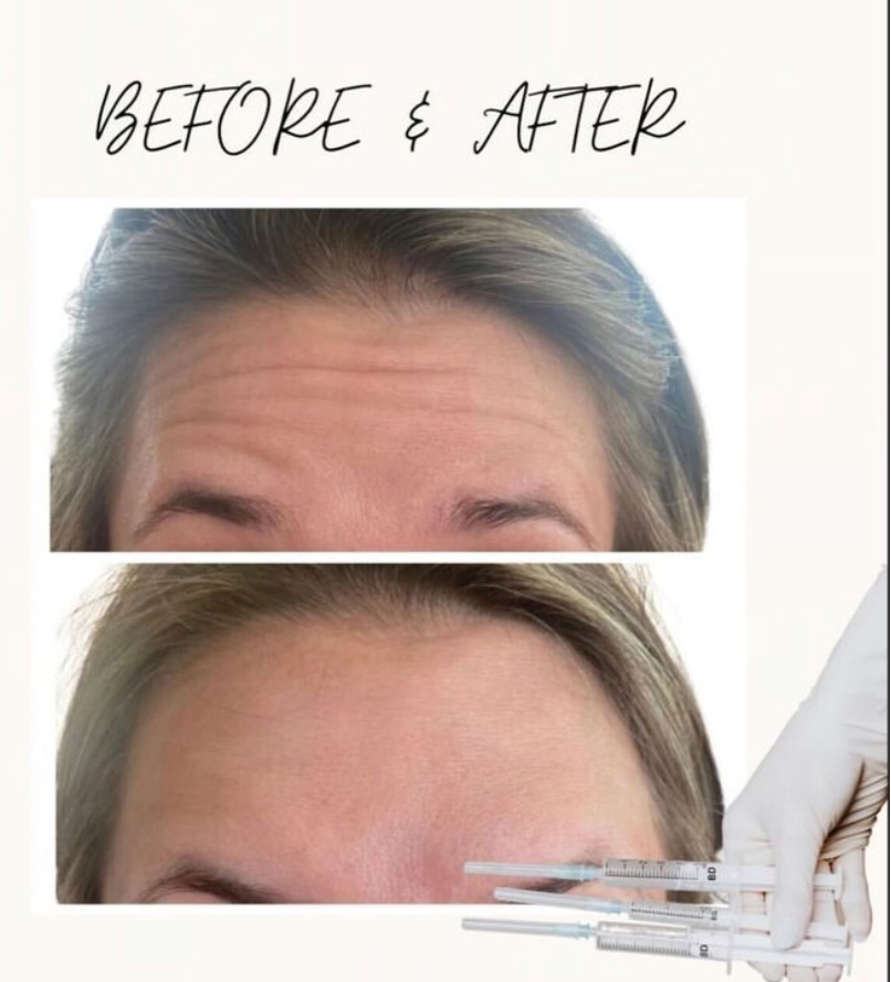 Xeomin wrinkle treatment before and after on forehead with smoother skin