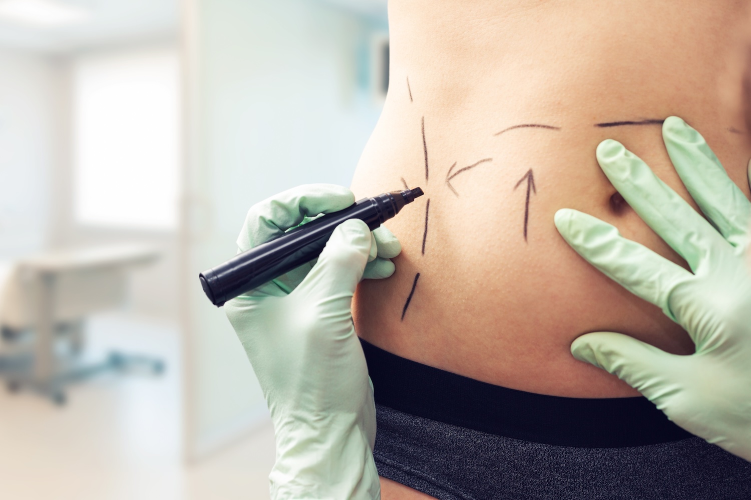 Gloved hands drawing guide lines with a marker on a person’s abdomen, shown in a close-up side view.
