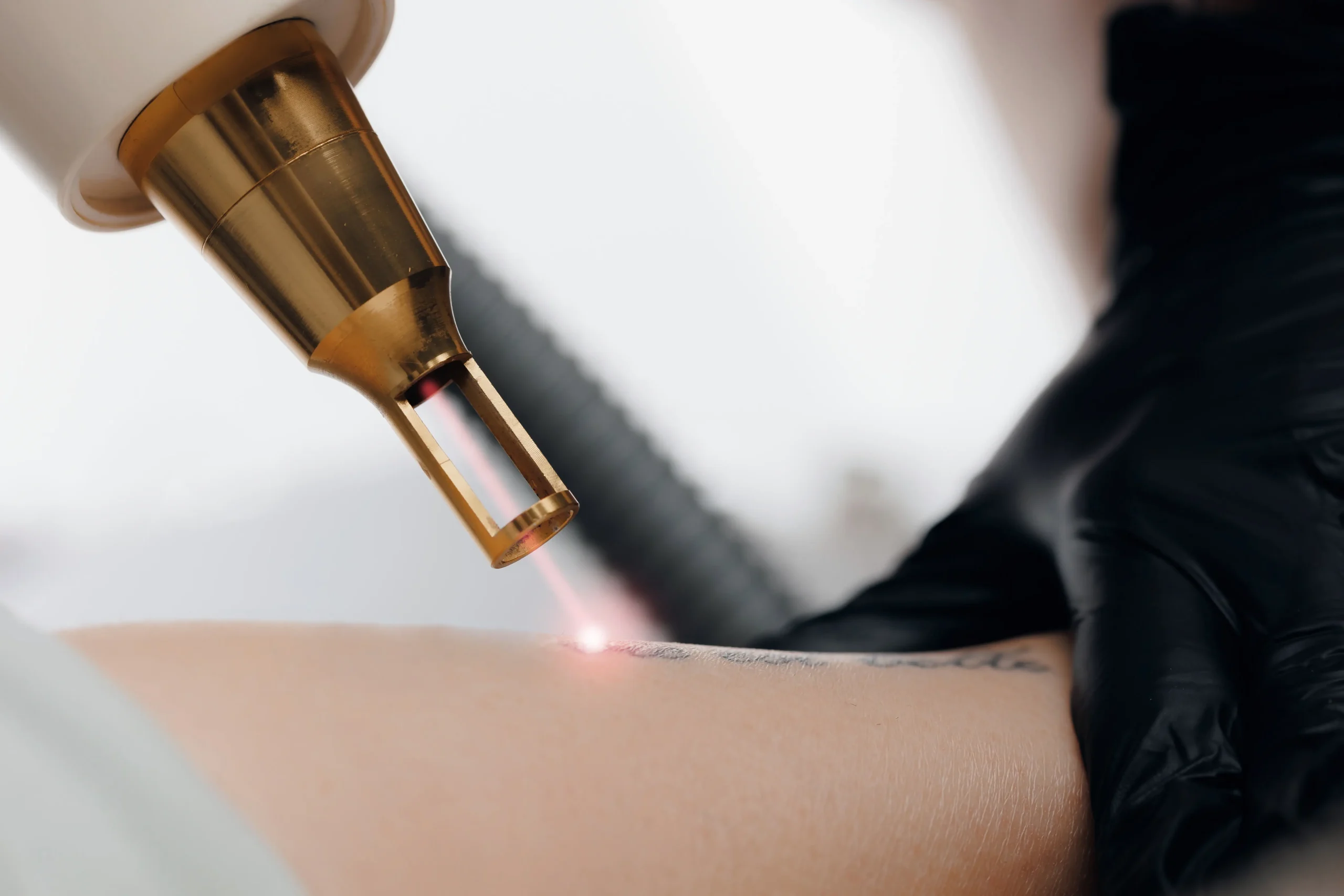 Close-up of a laser device emitting light onto a tattooed area of skin