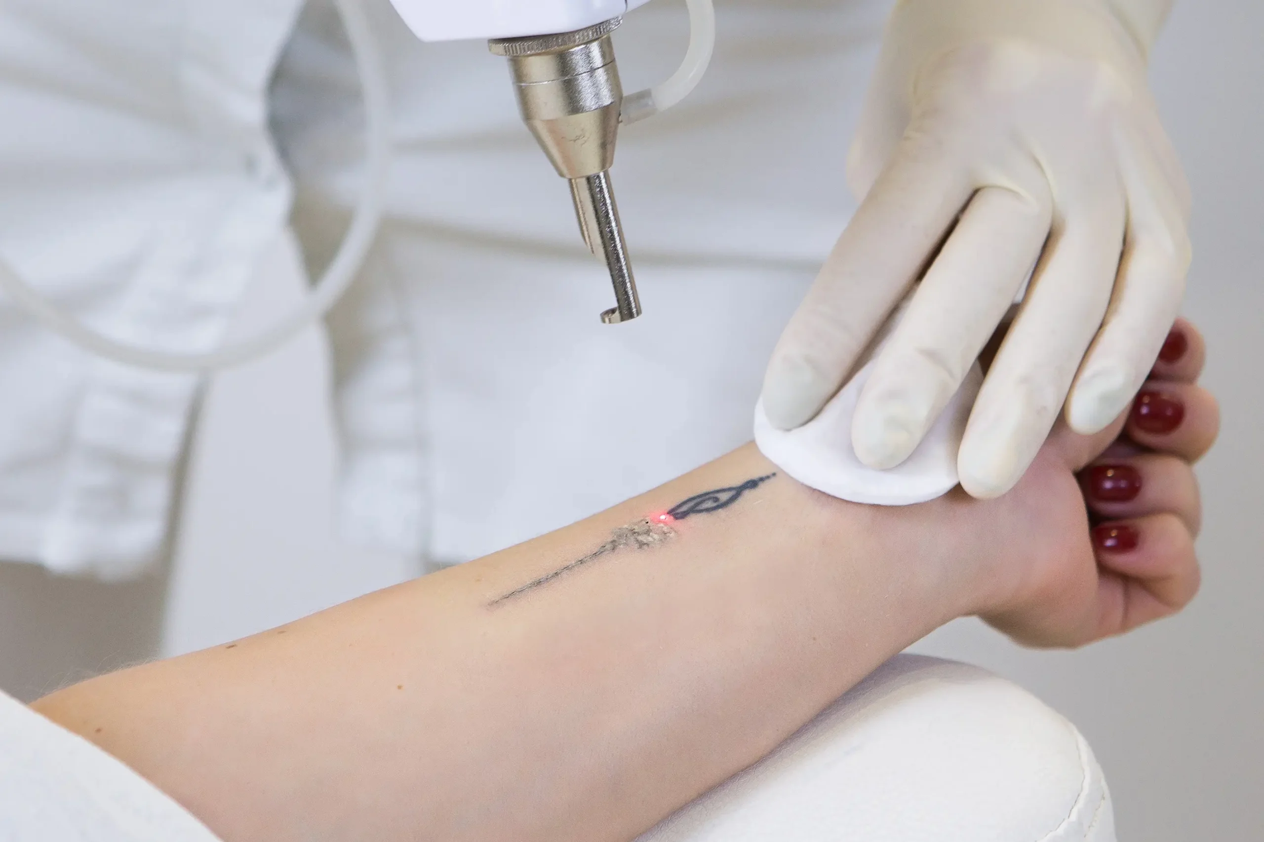 Laser device targeting a tattoo on a person's wrist during a removal treatment session